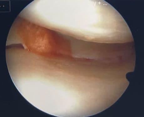 Arthroscopic view inside the joint, illustrating the meniscus in context